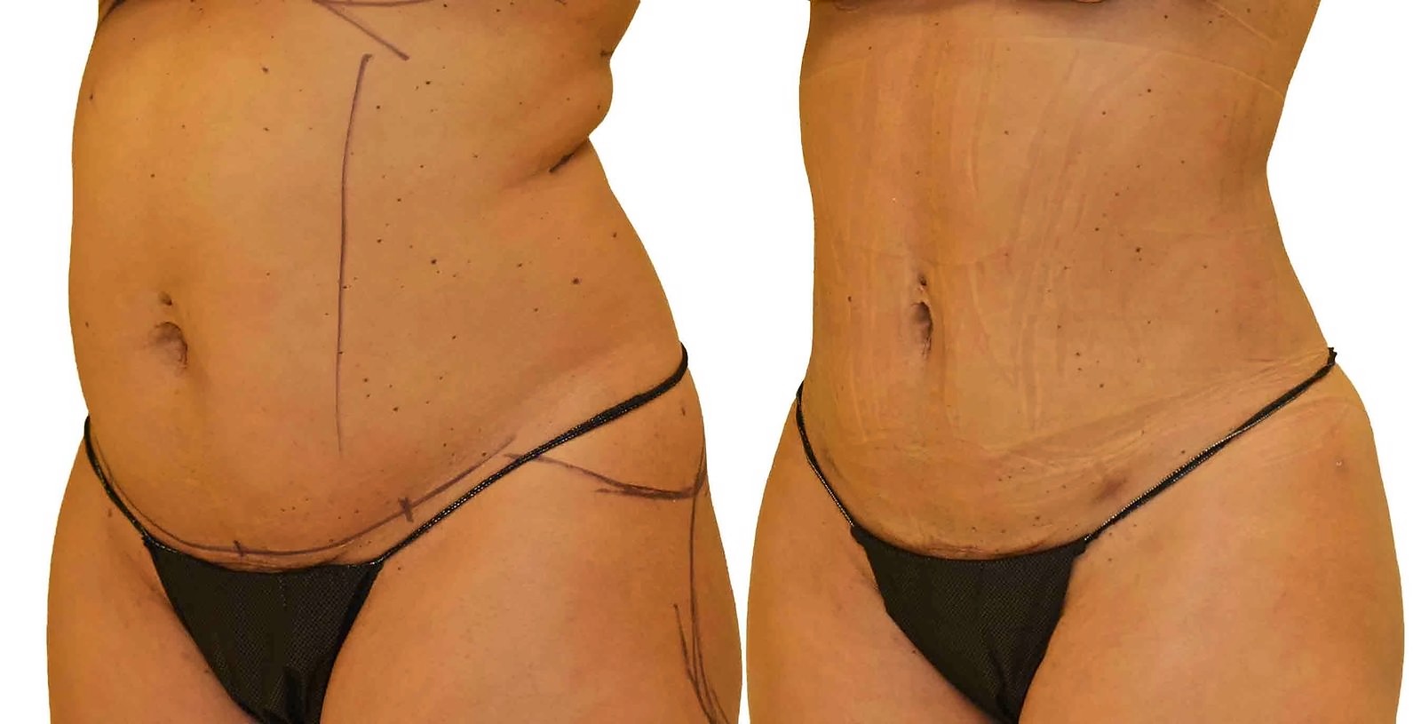 Before/After Lipo 360 before and after, actual patient of Dr. Long