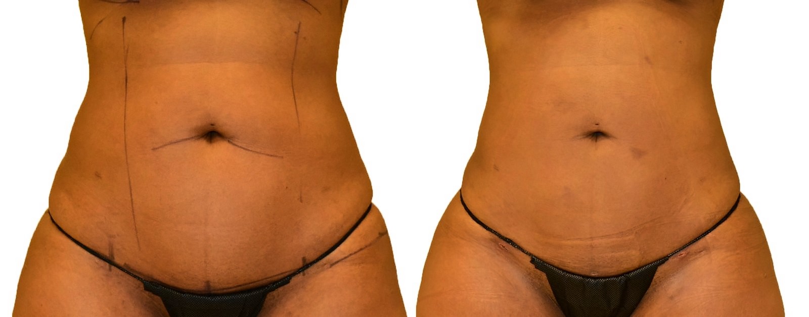 Before/After Lipo 360 before and after, actual patient of Dr. Long