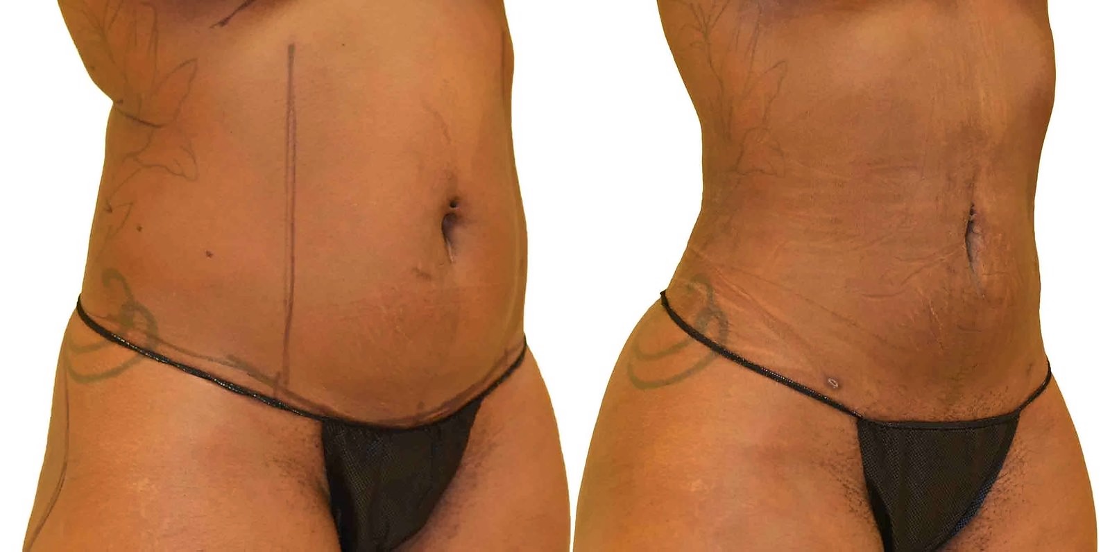 Before/After Lipo 360 before and after, actual patient of Dr. Long