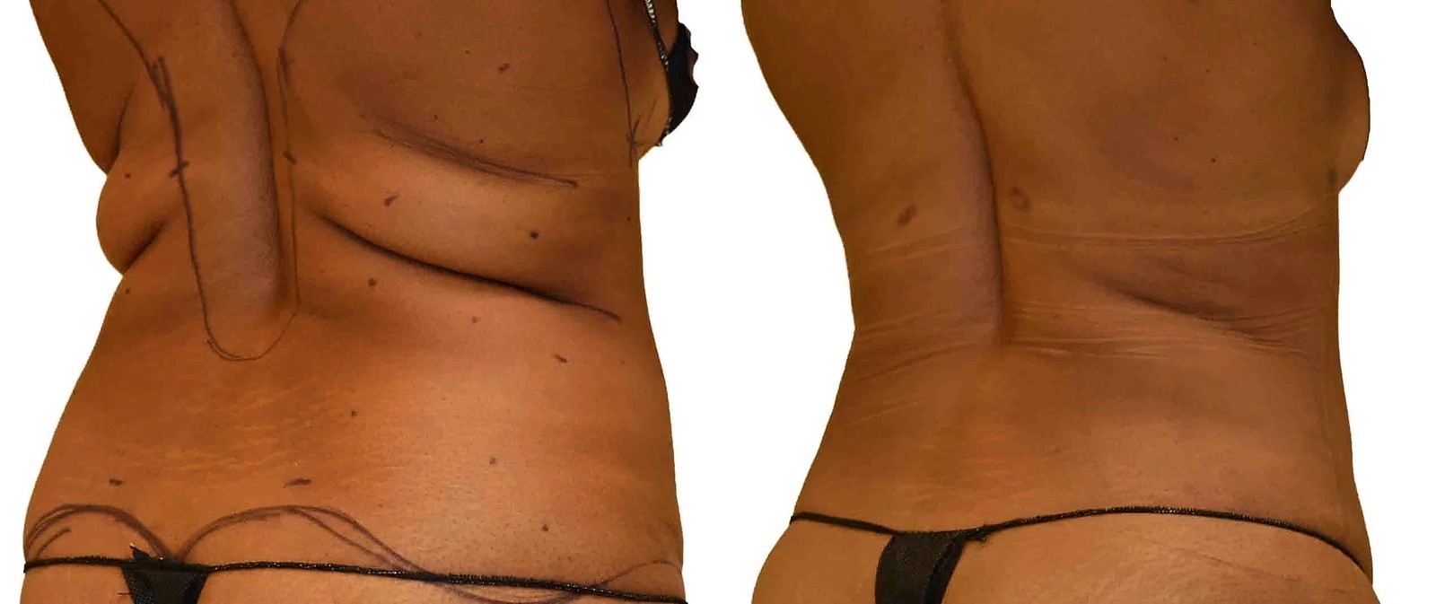 Before/After Lipo 360 before and after, actual patient of Dr. Long