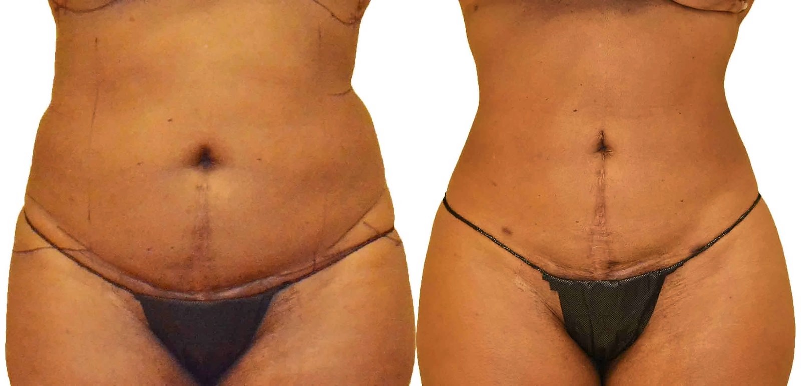 Before/After Lipo 360 before and after, actual patient of Dr. Long
