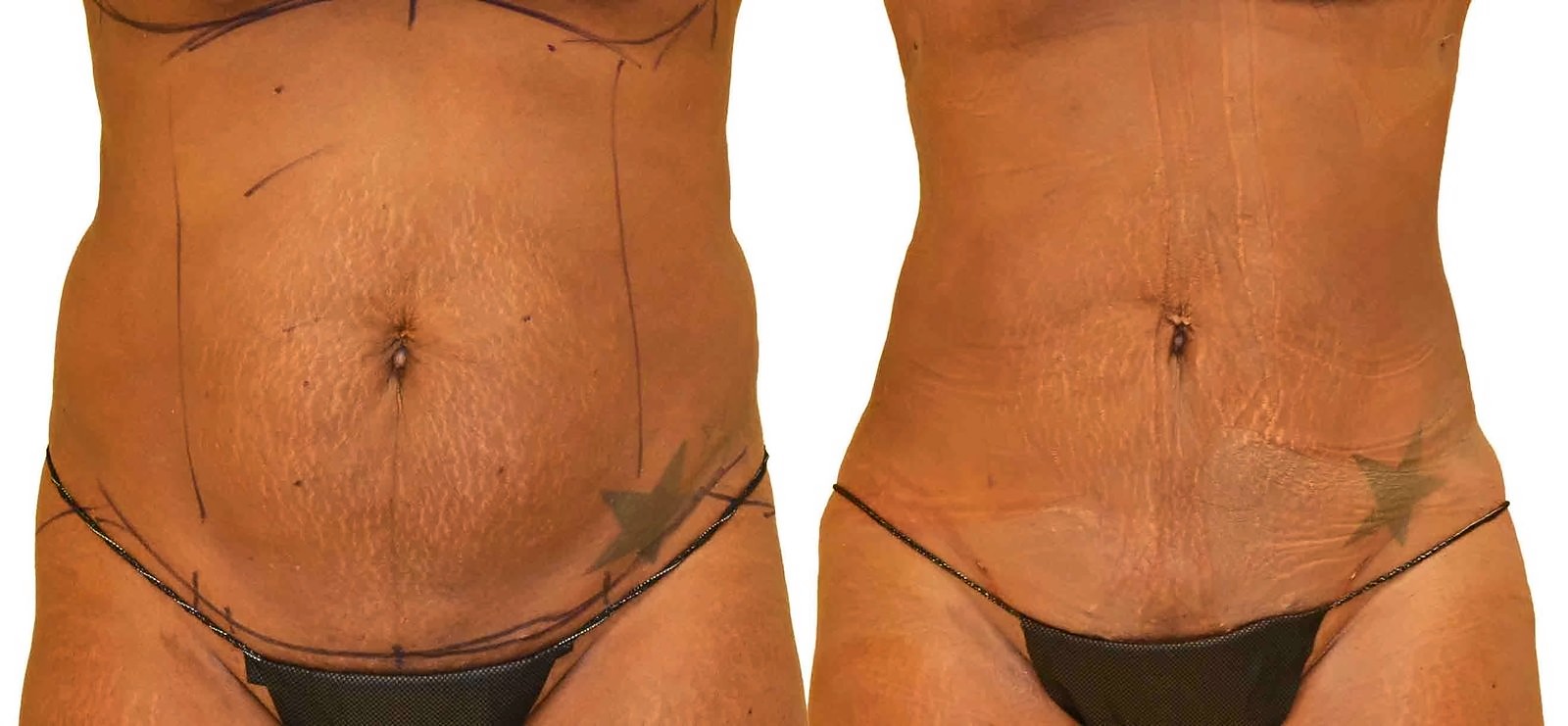 Before/After Lipo 360 before and after, actual patient of Dr. Long