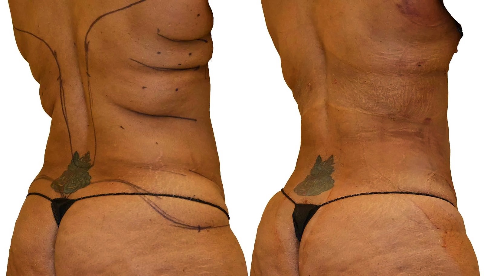 Before/After Lipo 360 before and after, actual patient of Dr. Long