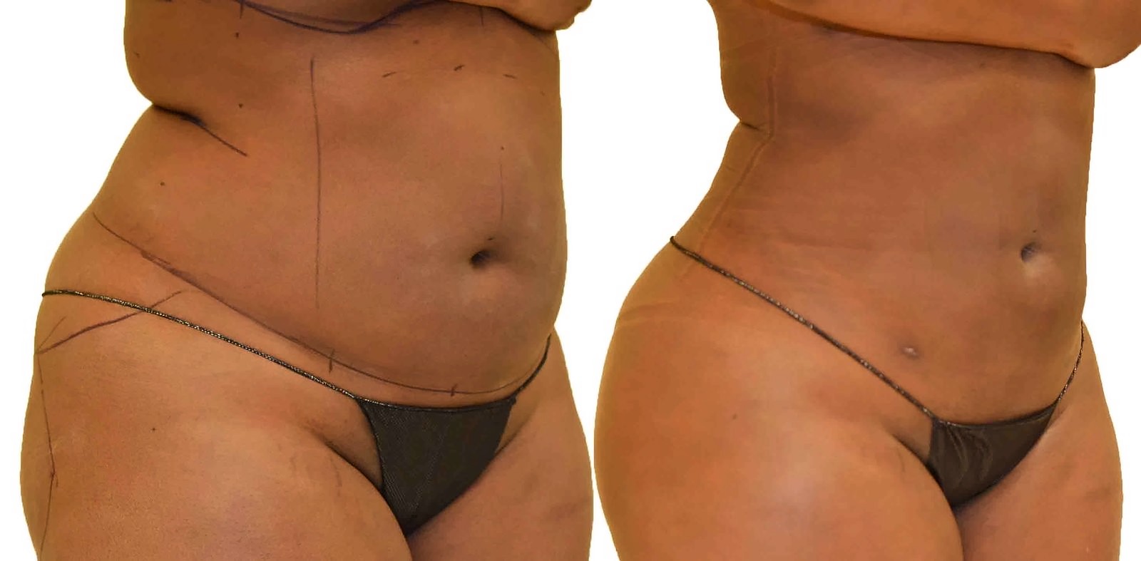 Before/After Lipo 360 before and after, actual patient of Dr. Long