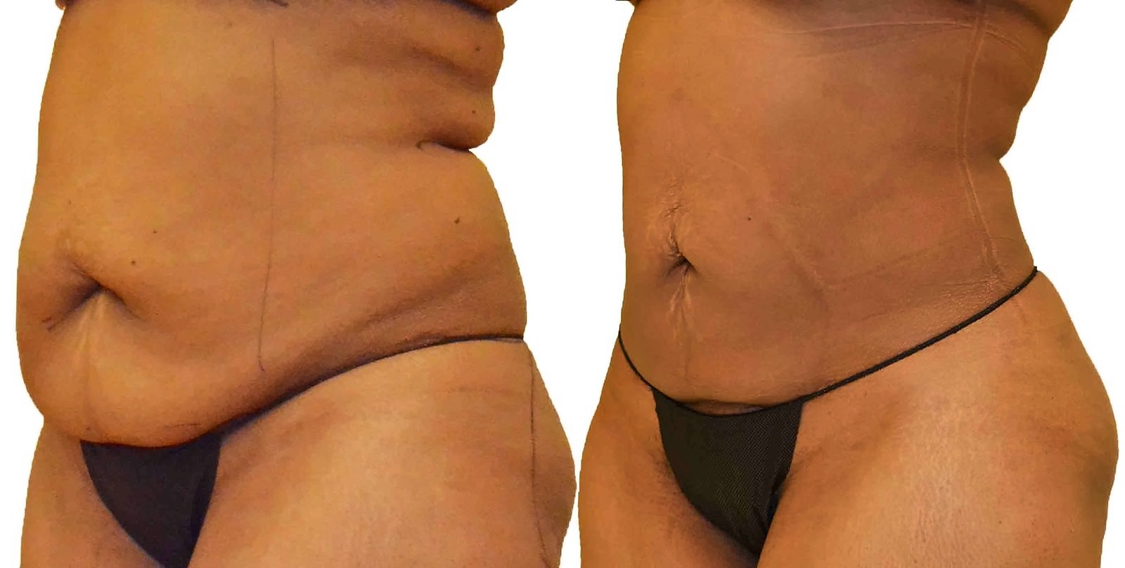 Before/After Lipo 360 before and after, actual patient of Dr. Long