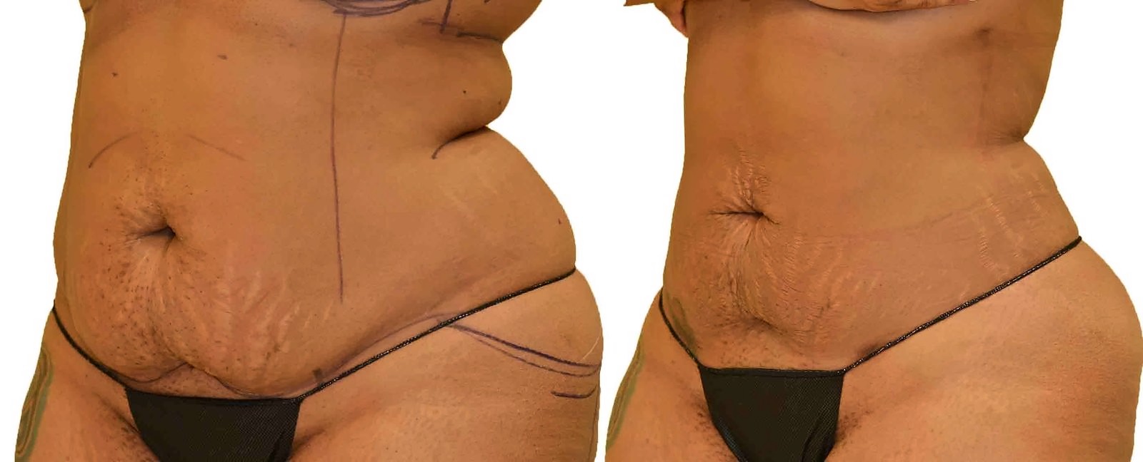 Before/After Lipo 360 before and after, actual patient of Dr. Long