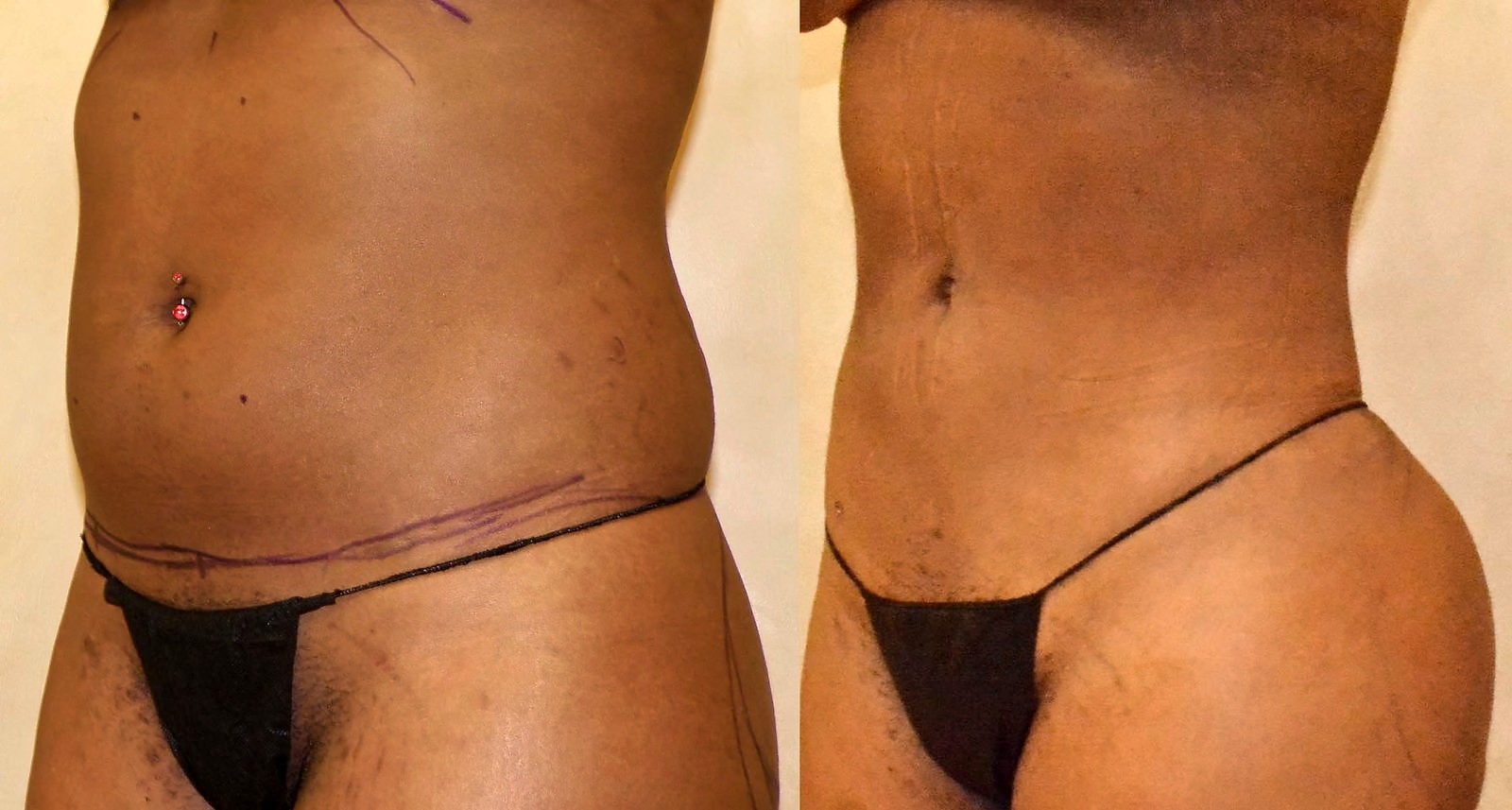 Before/After Lipo 360 before and after, actual patient of Dr. Long