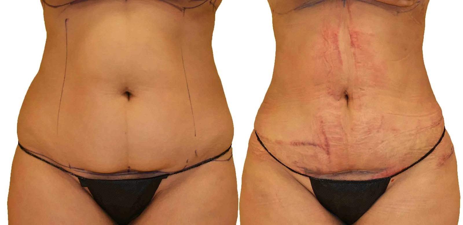 Before/After Lipo 360 before and after, actual patient of Dr. Long
