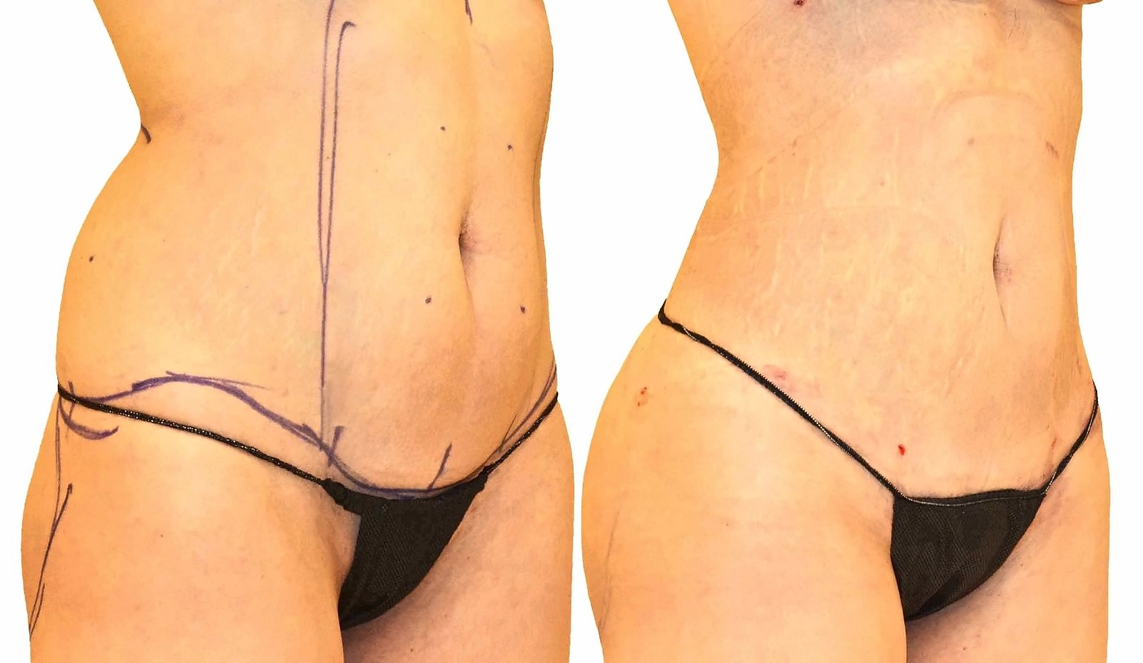 Before/After Lipo 360 before and after, actual patient of Dr. Long
