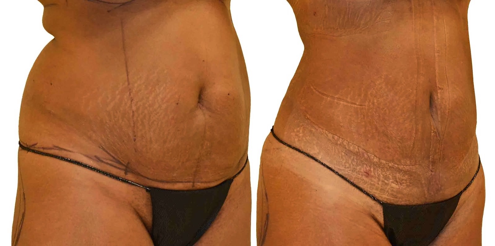 Before/After Lipo 360 before and after, actual patient of Dr. Long
