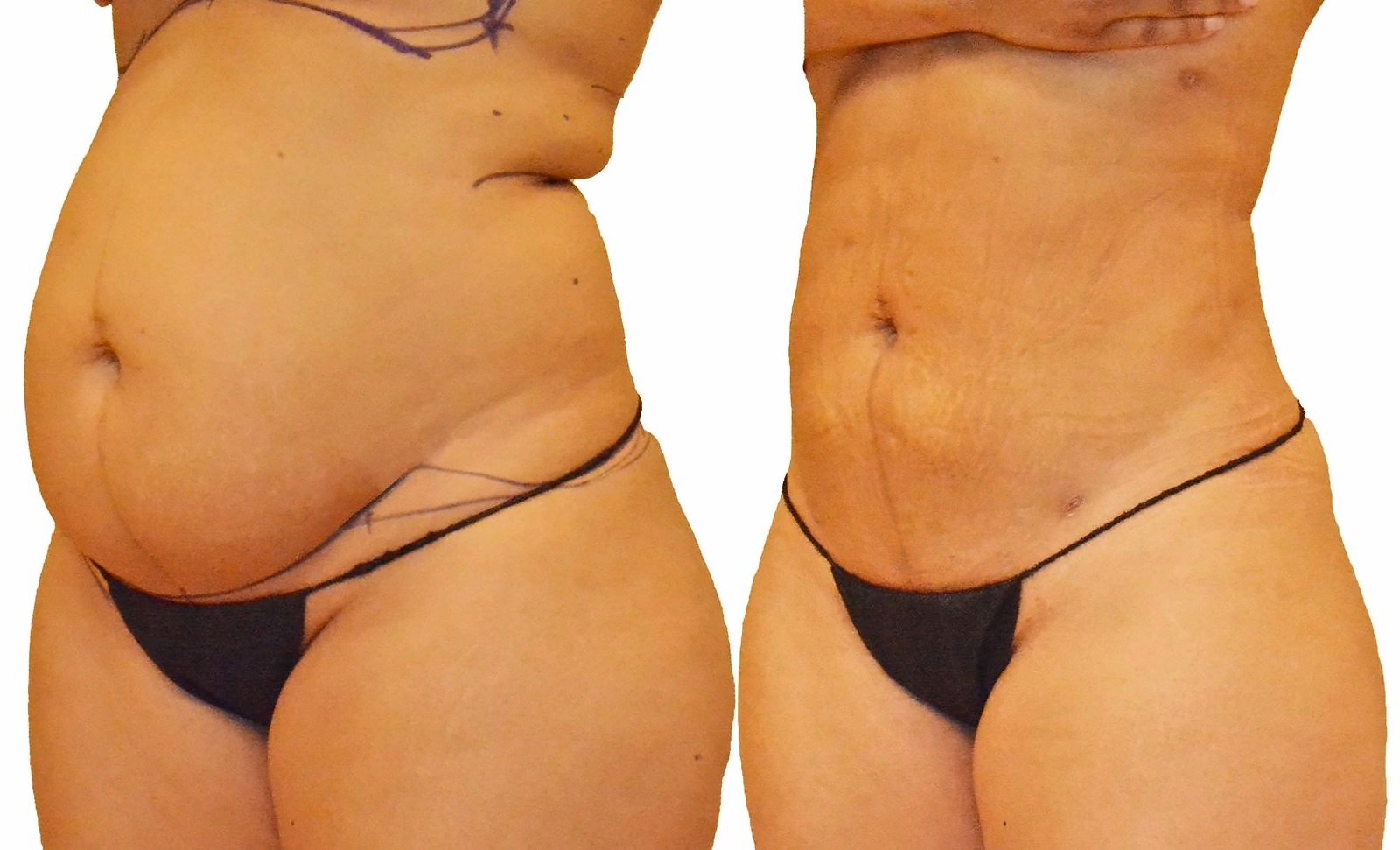 Before/After Lipo 360 before and after, actual patient of Dr. Long