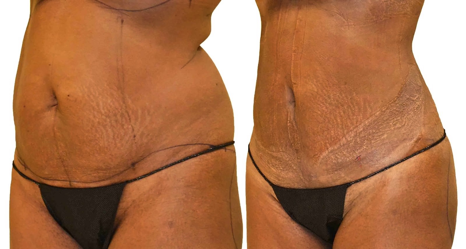 Before/After Lipo 360 before and after, actual patient of Dr. Long
