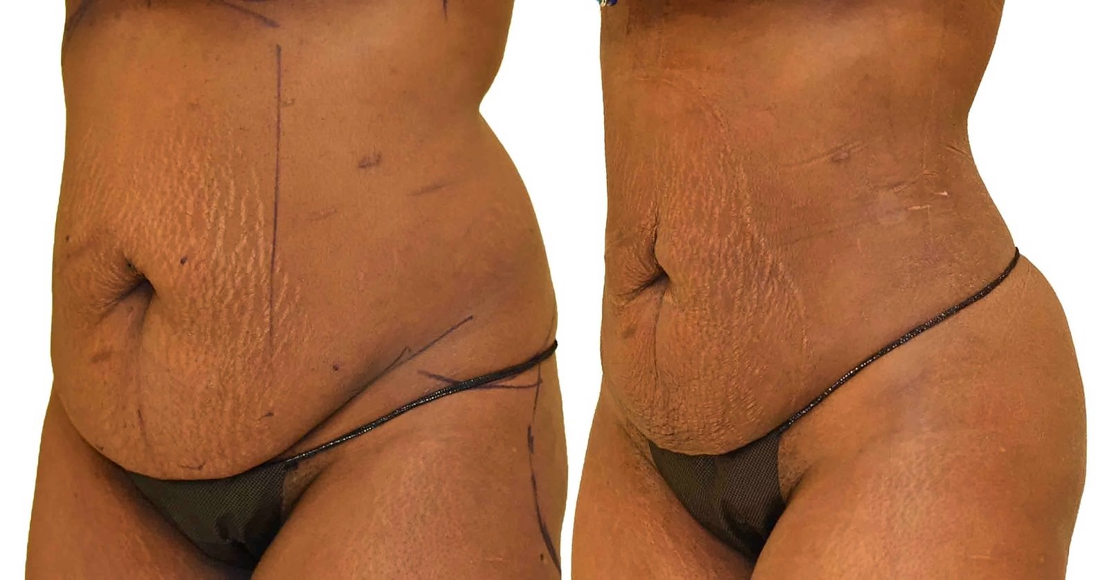 Before/After Lipo 360 before and after, actual patient of Dr. Long