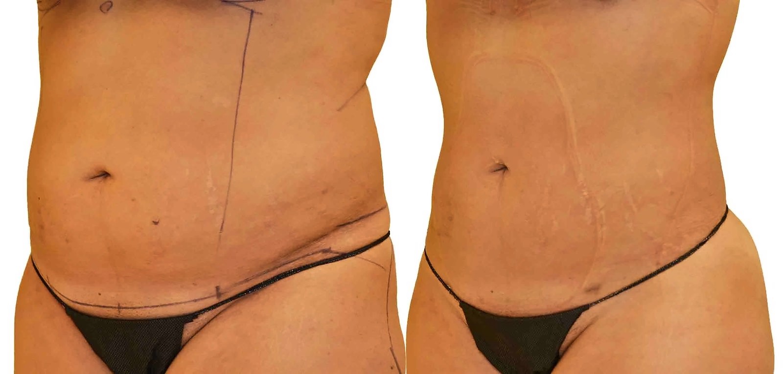 Before/After Lipo 360 before and after, actual patient of Dr. Long
