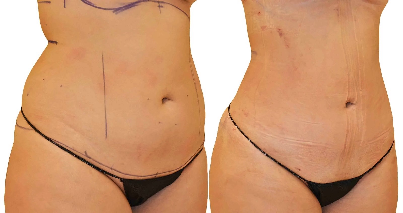 Before/After Lipo 360 before and after, actual patient of Dr. Long