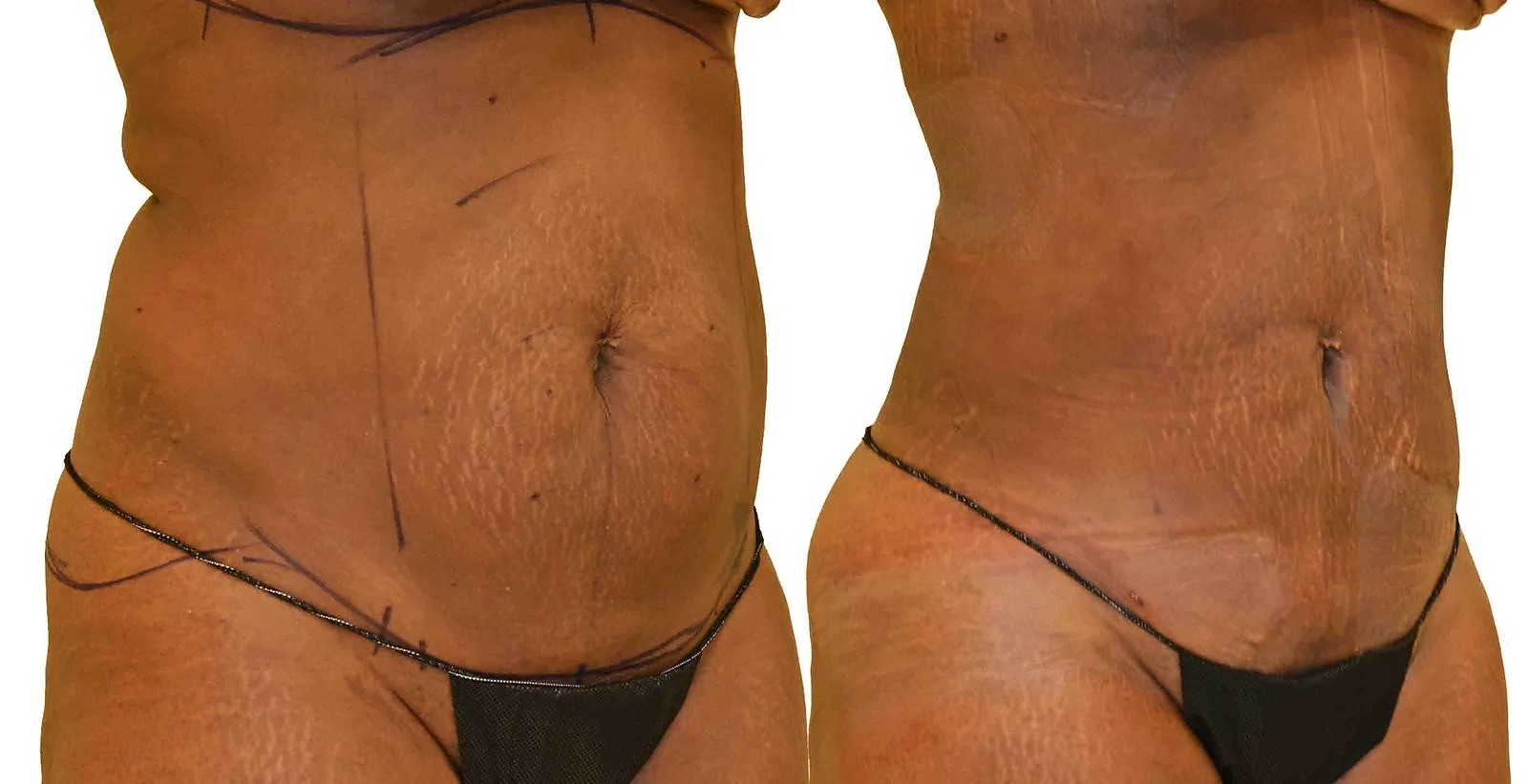 Before/After Lipo 360 before and after, actual patient of Dr. Long
