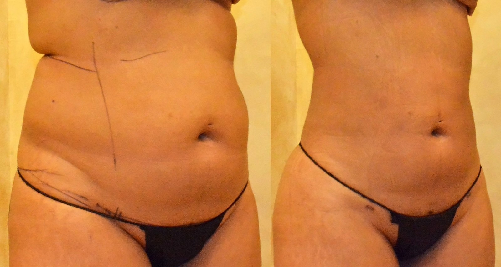 Before/After Lipo 360 before and after, actual patient of Dr. Long