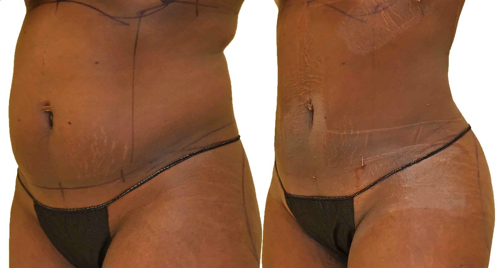 Before/After Lipo 360 before and after, actual patient of Dr. Long