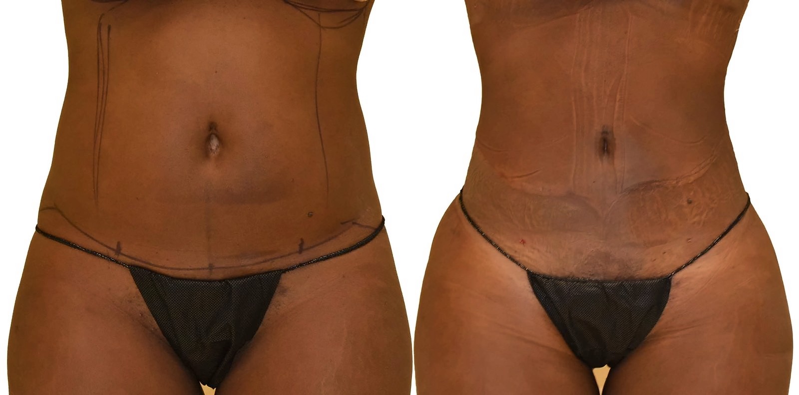 Before/After Lipo 360 before and after, actual patient of Dr. Long
