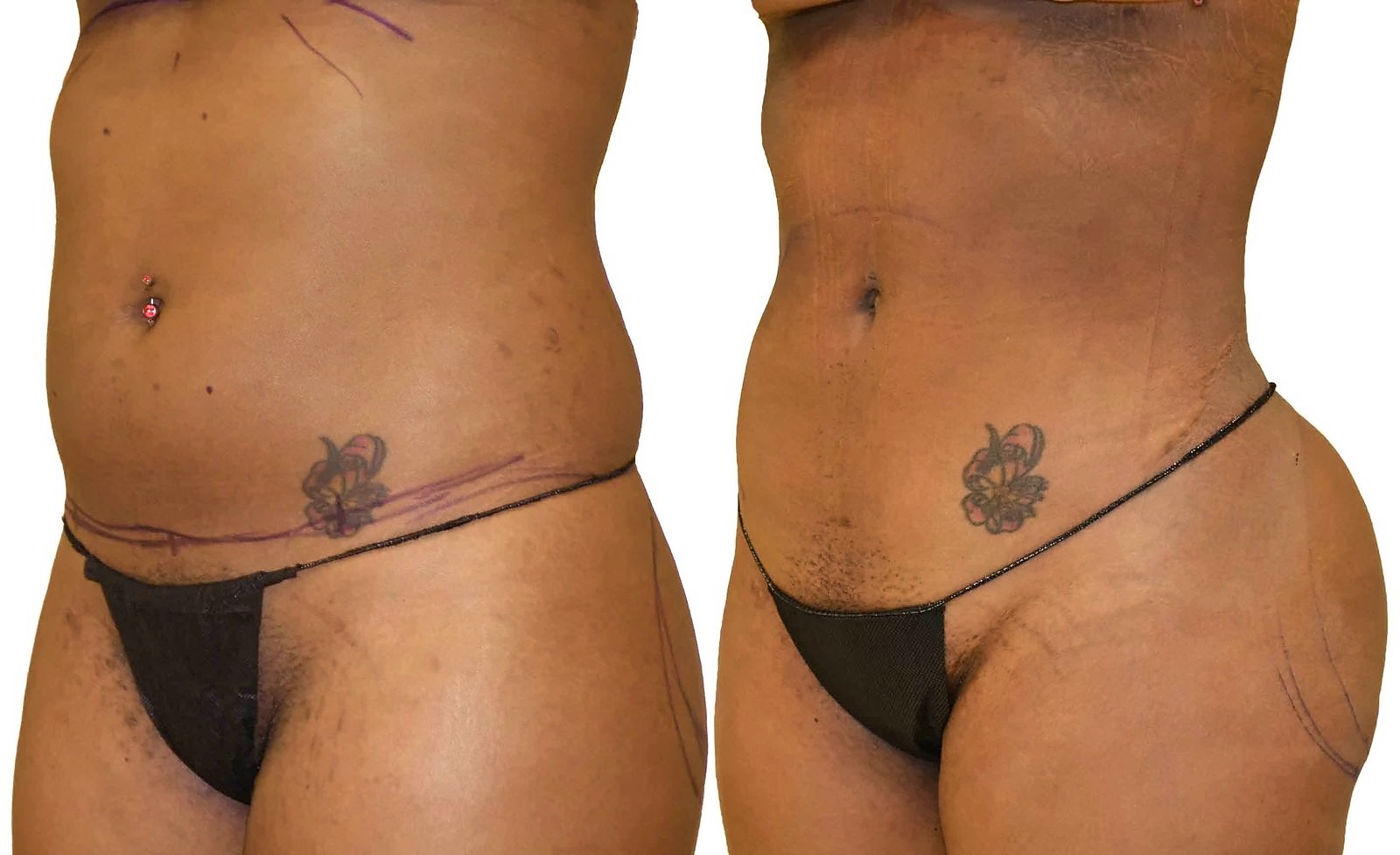 Before/After Lipo 360 before and after, actual patient of Dr. Long
