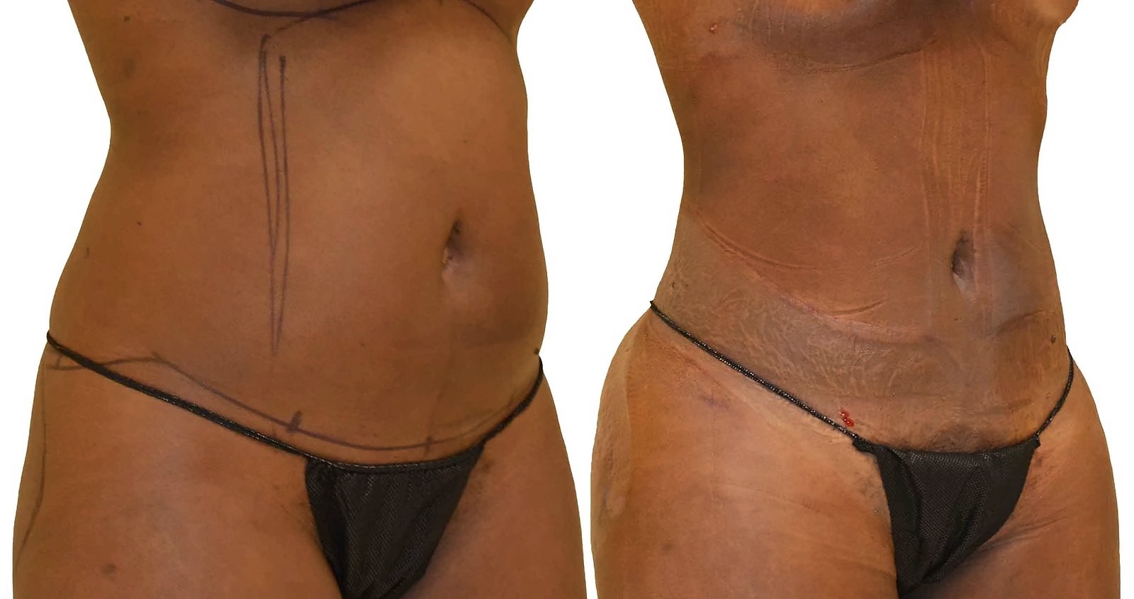 Before/After Lipo 360 before and after, actual patient of Dr. Long