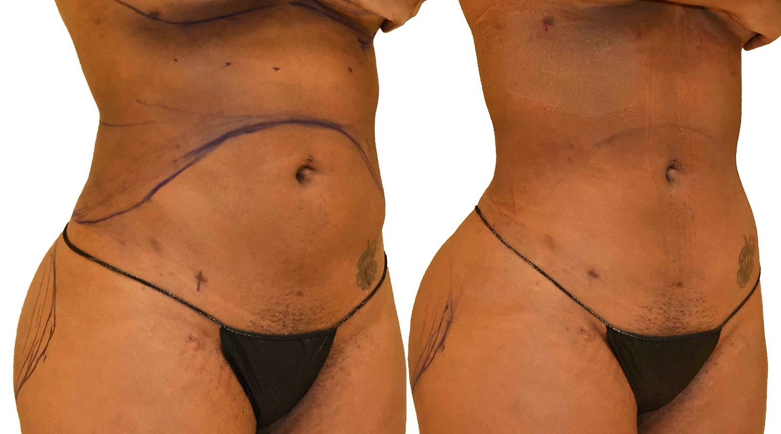 Before/After Lipo 360 before and after, actual patient of Dr. Long