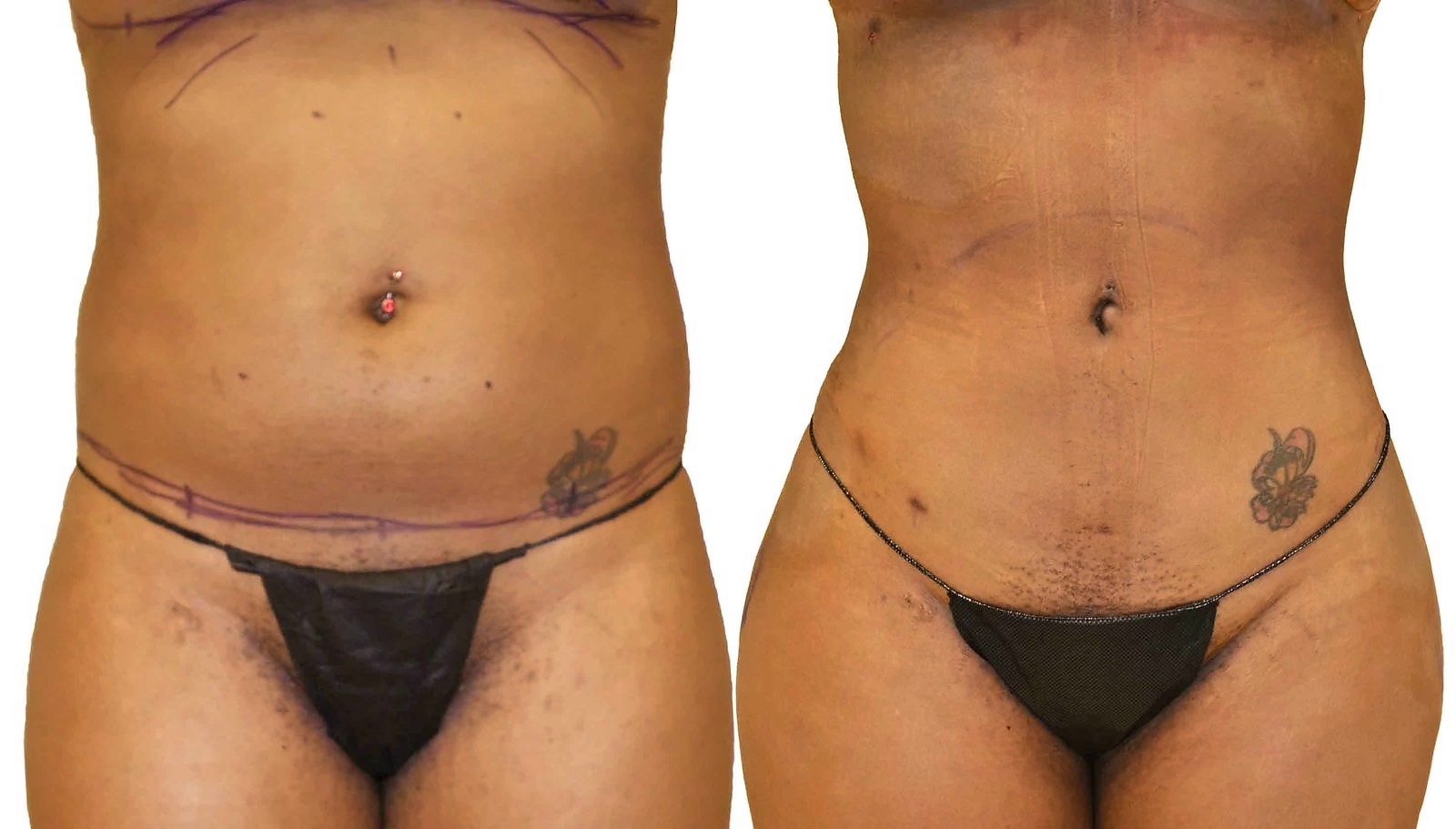 Before/After Lipo 360 before and after, actual patient of Dr. Long