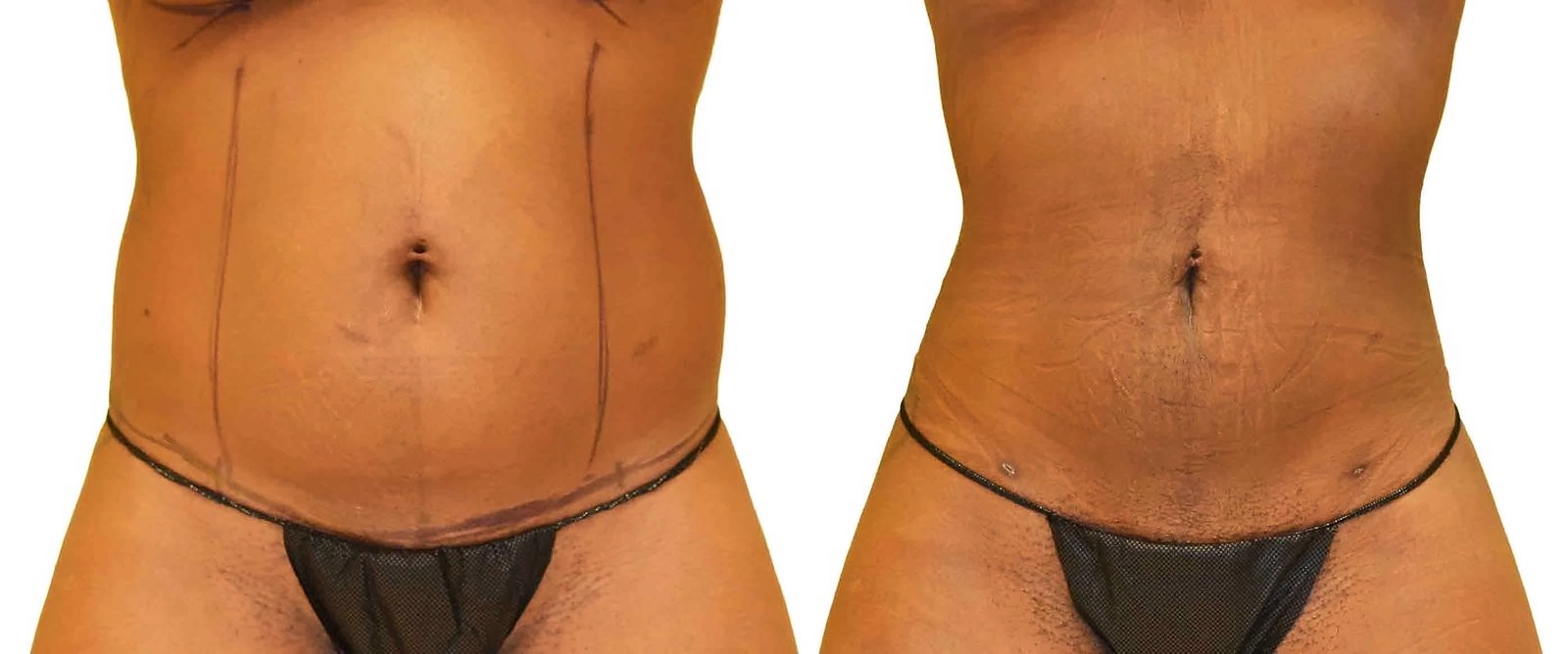 Before/After Lipo 360 before and after, actual patient of Dr. Long
