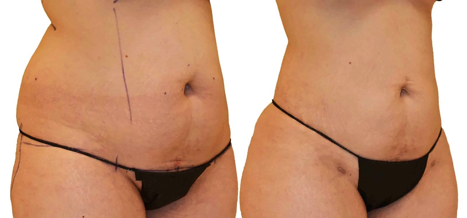 Before/After Lipo 360 before and after, actual patient of Dr. Long