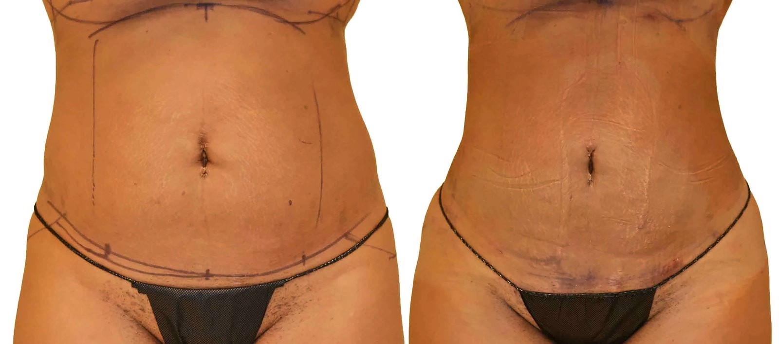Before/After Lipo 360 before and after, actual patient of Dr. Long