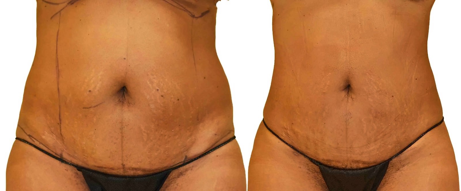 Before/After Lipo 360 before and after, actual patient of Dr. Long