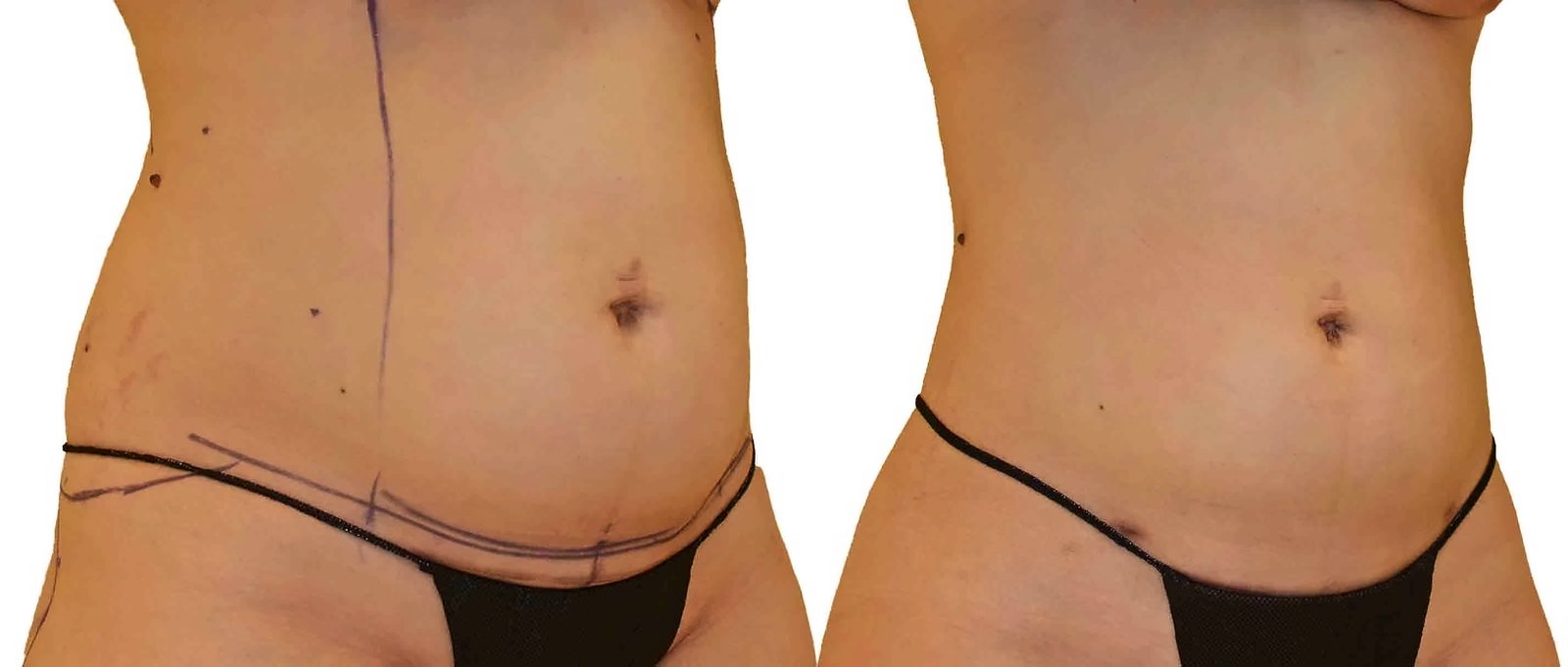 Before/After Lipo 360 before and after, actual patient of Dr. Long