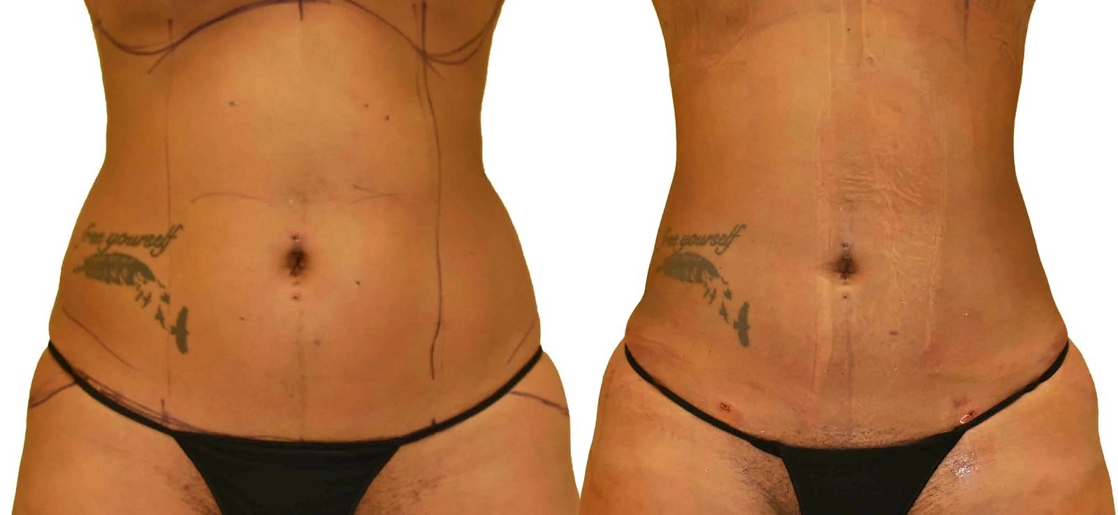 Before/After Lipo 360 before and after, actual patient of Dr. Long