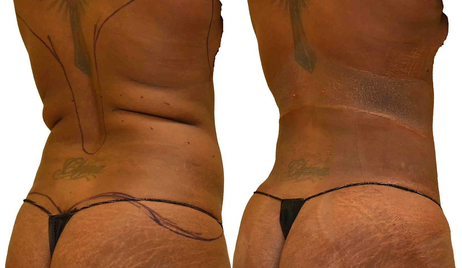 Before/After Lipo 360 before and after, actual patient of Dr. Long