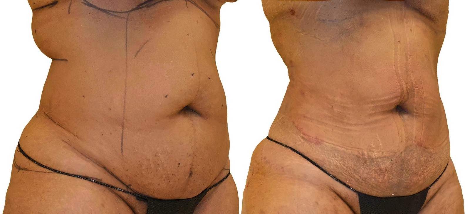 Before/After Lipo 360 before and after, actual patient of Dr. Long