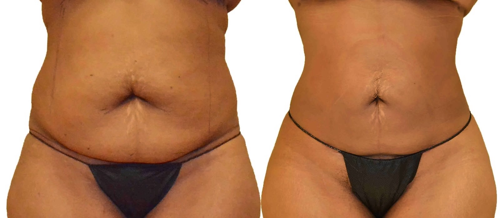 Before/After Lipo 360 before and after, actual patient of Dr. Long