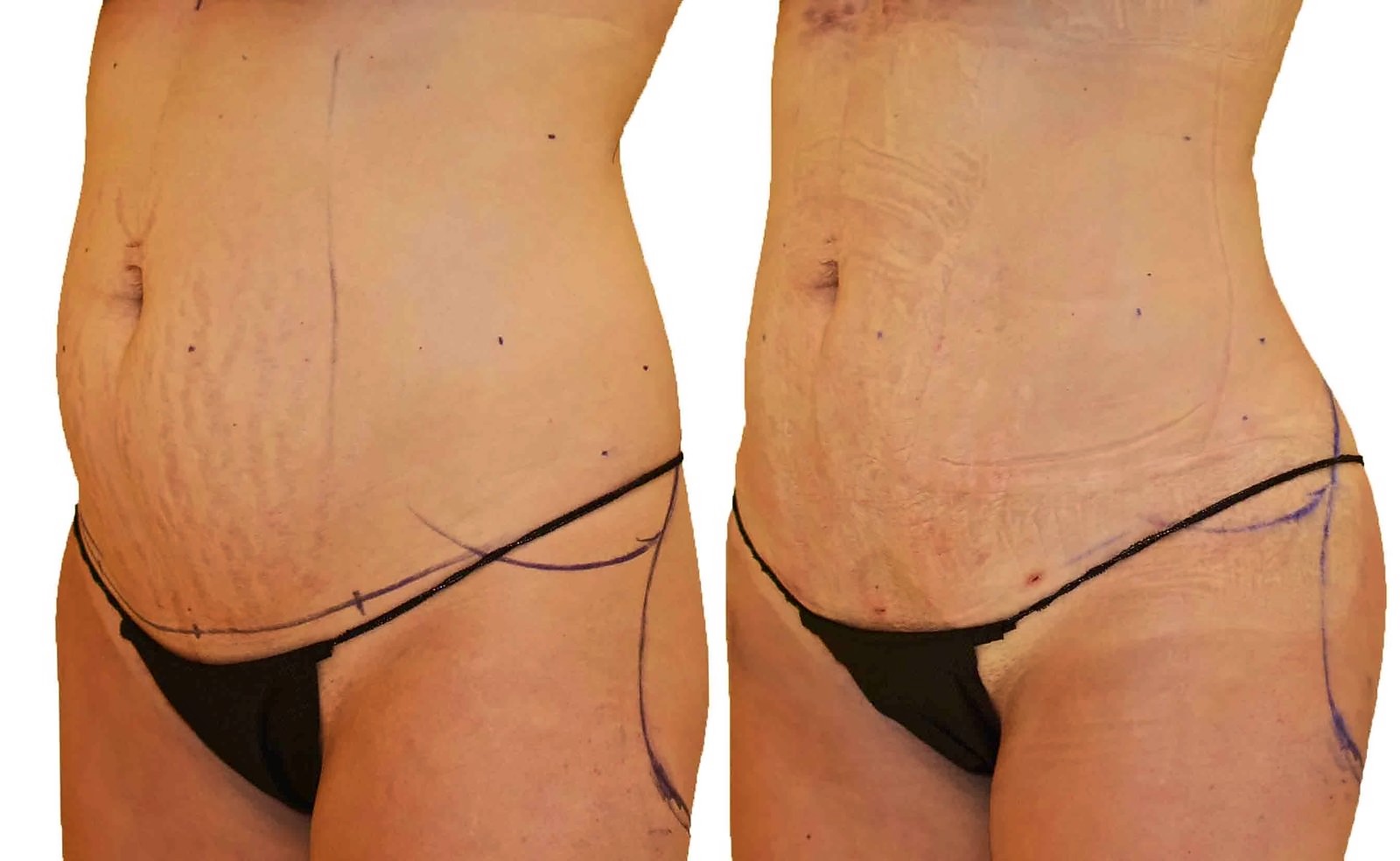 Before/After Lipo 360 before and after, actual patient of Dr. Long