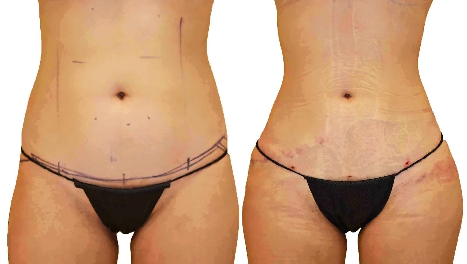 Before/After Lipo 360 before and after, actual patient of Dr. Long