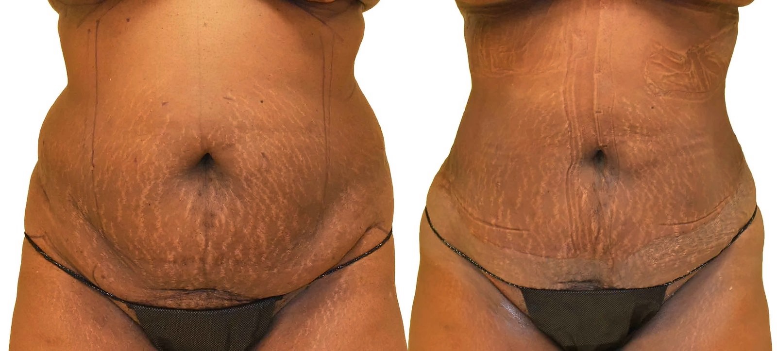 Before/After Lipo 360 before and after, actual patient of Dr. Long