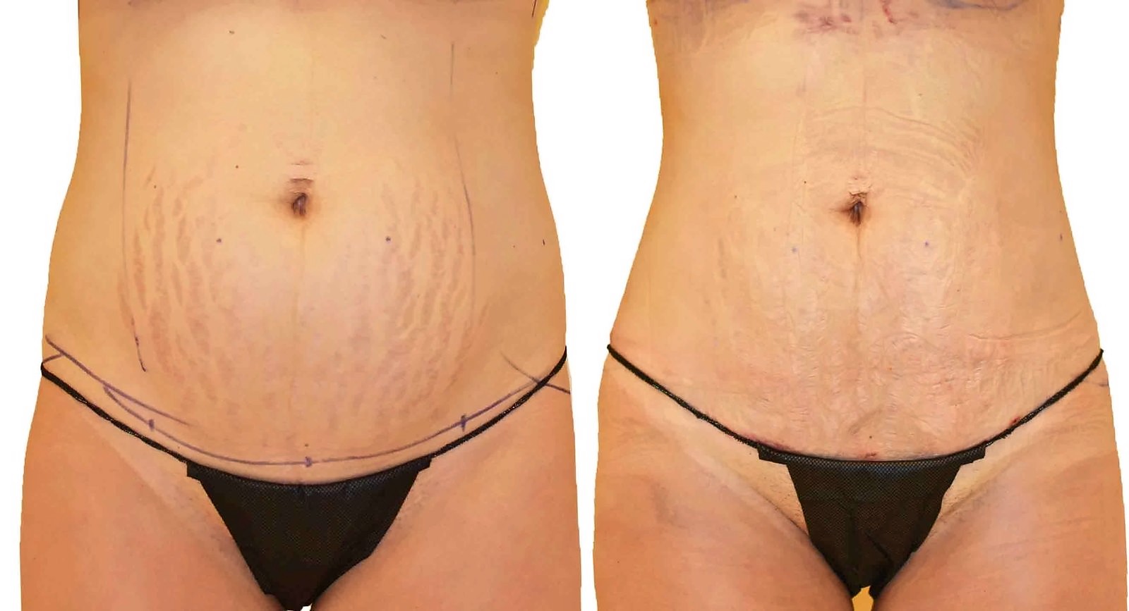 Before/After Lipo 360 before and after, actual patient of Dr. Long