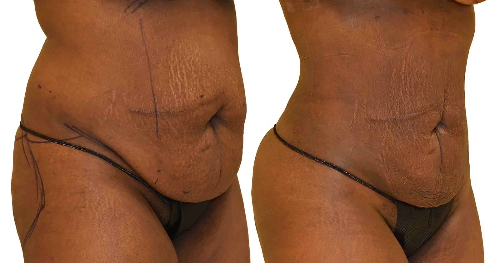 Before/After Lipo 360 before and after, actual patient of Dr. Long