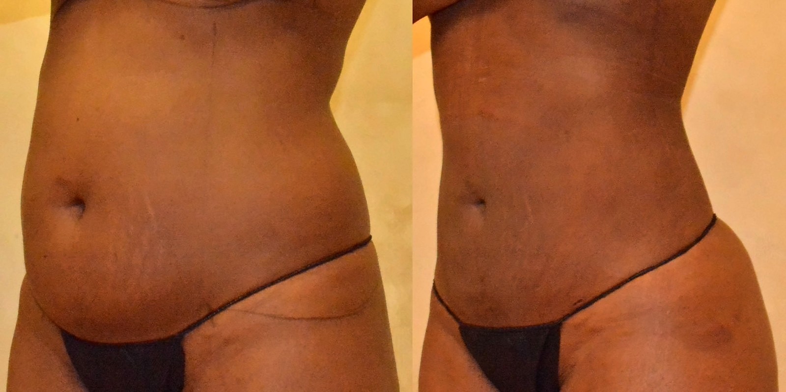 Before/After Lipo 360 before and after, actual patient of Dr. Long