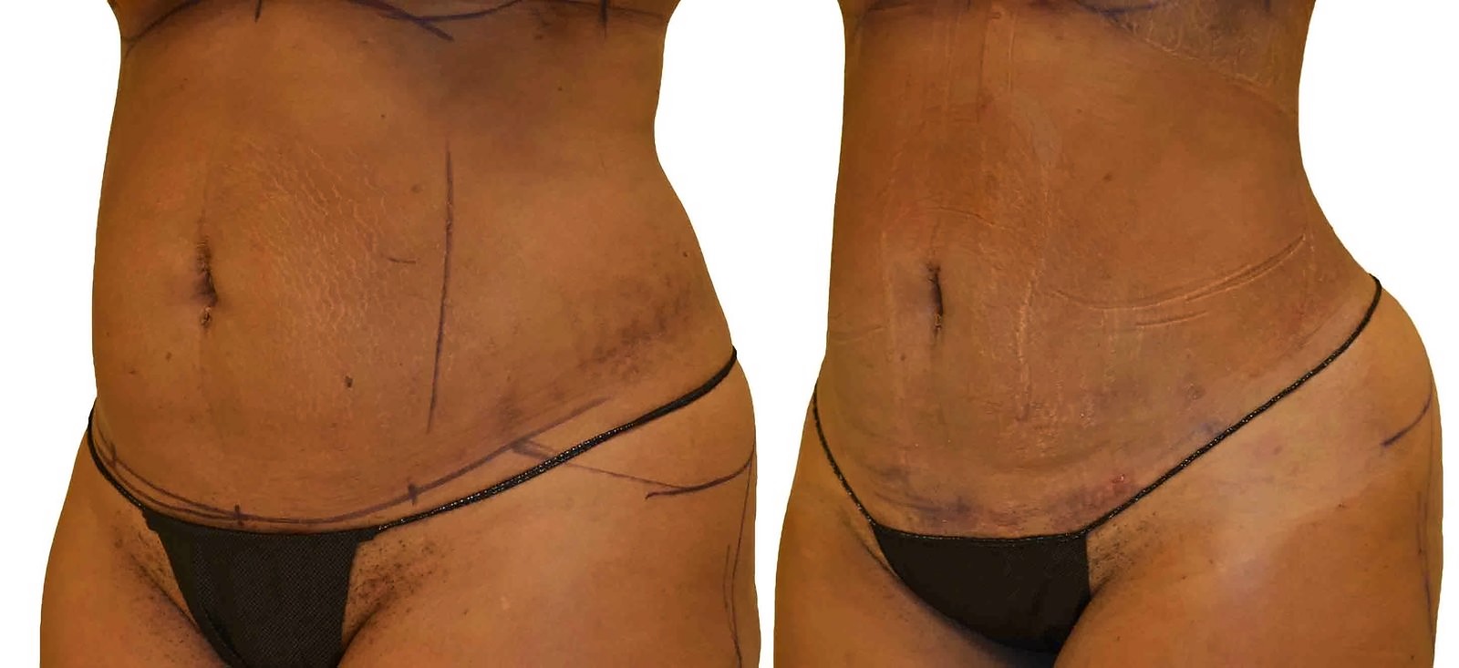Before/After Lipo 360 before and after, actual patient of Dr. Long
