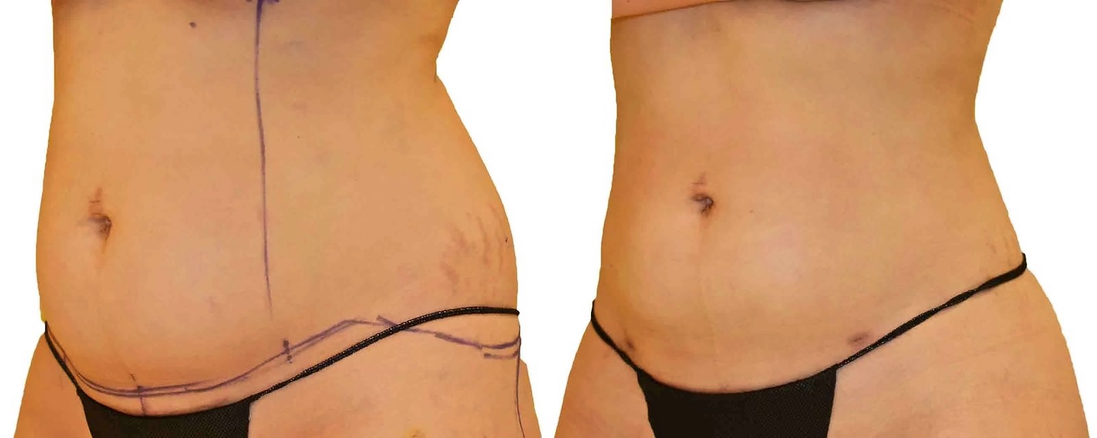 Before/After Lipo 360 before and after, actual patient of Dr. Long