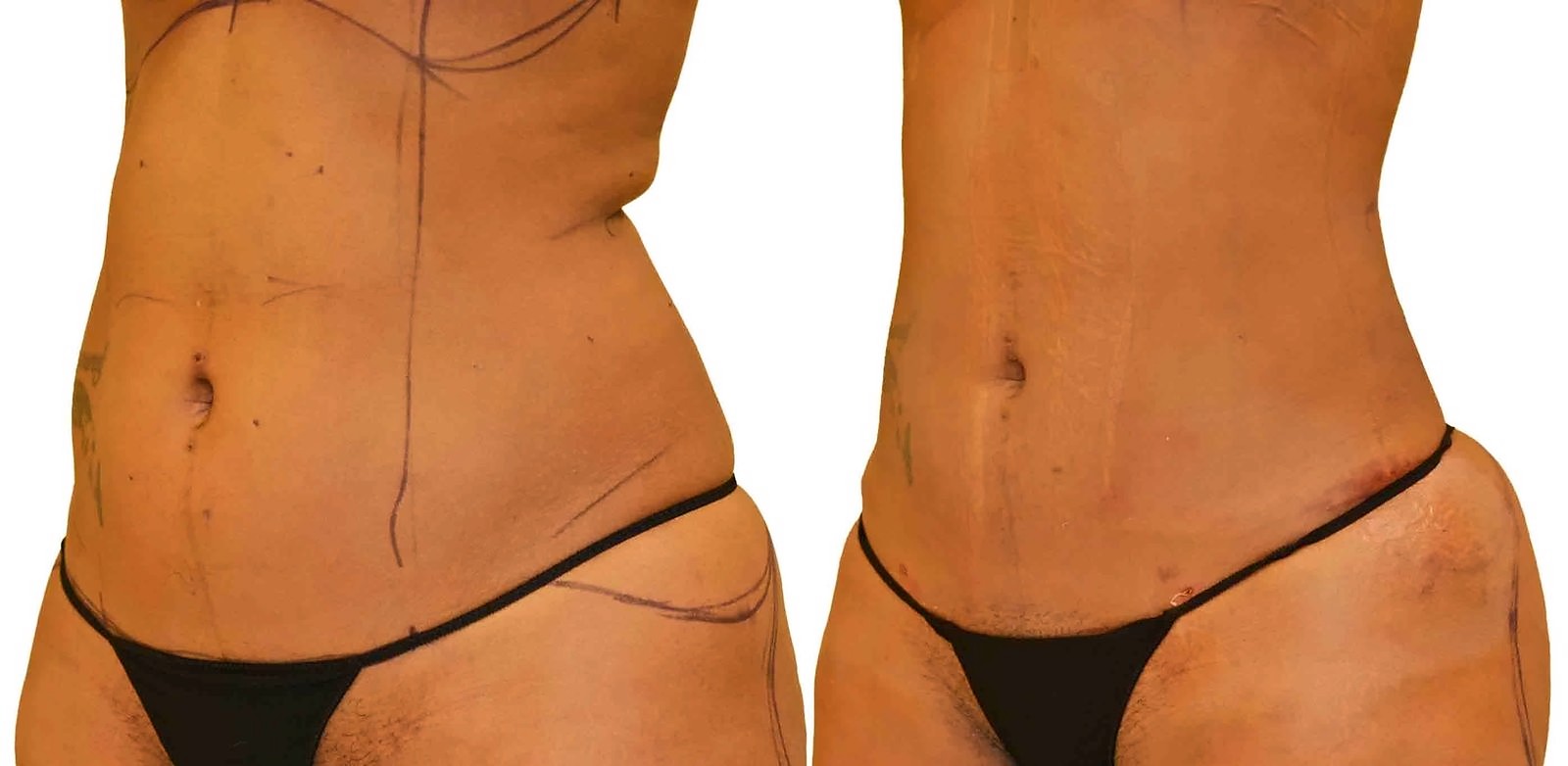 Before/After Lipo 360 before and after, actual patient of Dr. Long