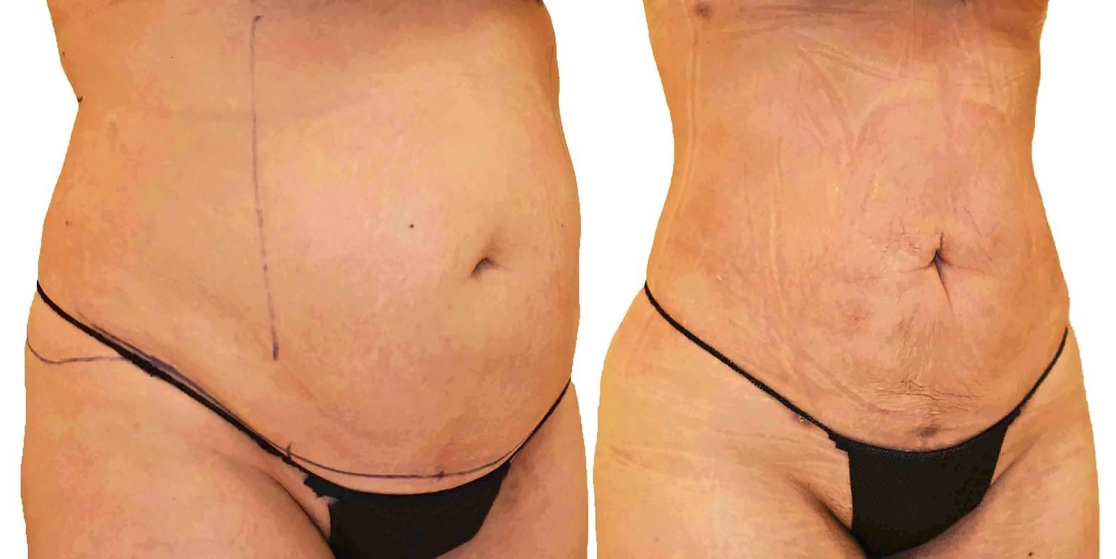 Before/After Lipo 360 before and after, actual patient of Dr. Long