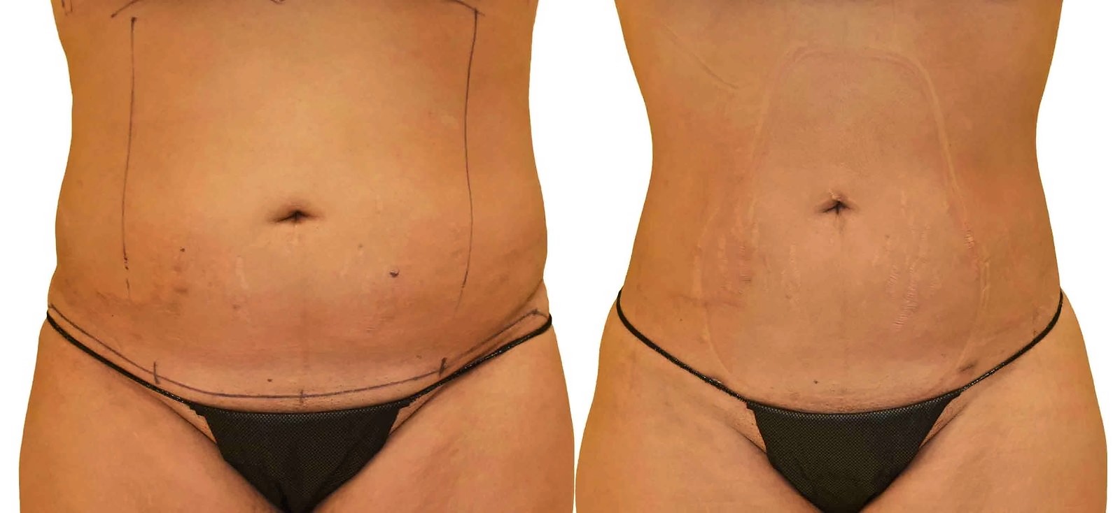 Before/After Lipo 360 before and after, actual patient of Dr. Long