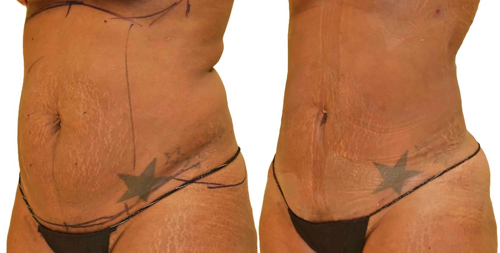 Before/After Lipo 360 before and after, actual patient of Dr. Long