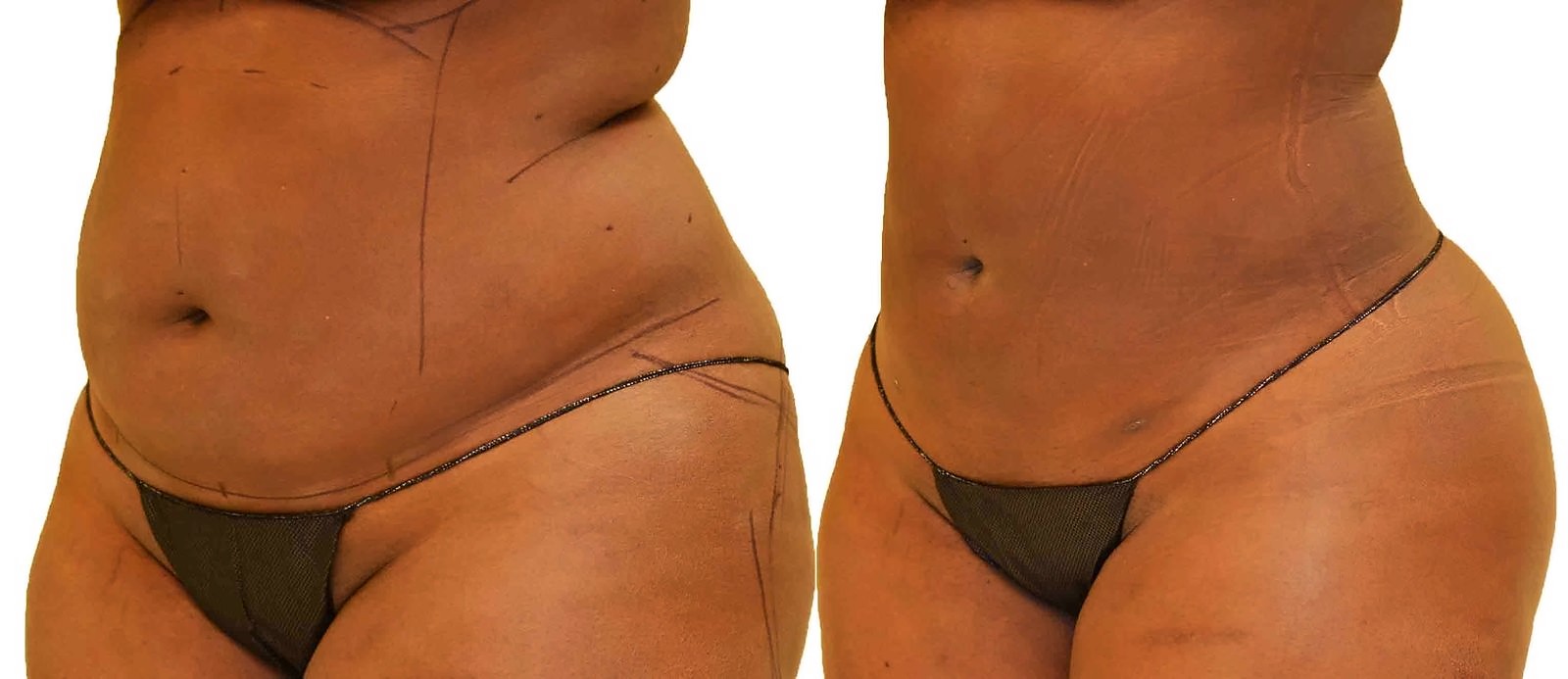 Before/After Lipo 360 before and after, actual patient of Dr. Long