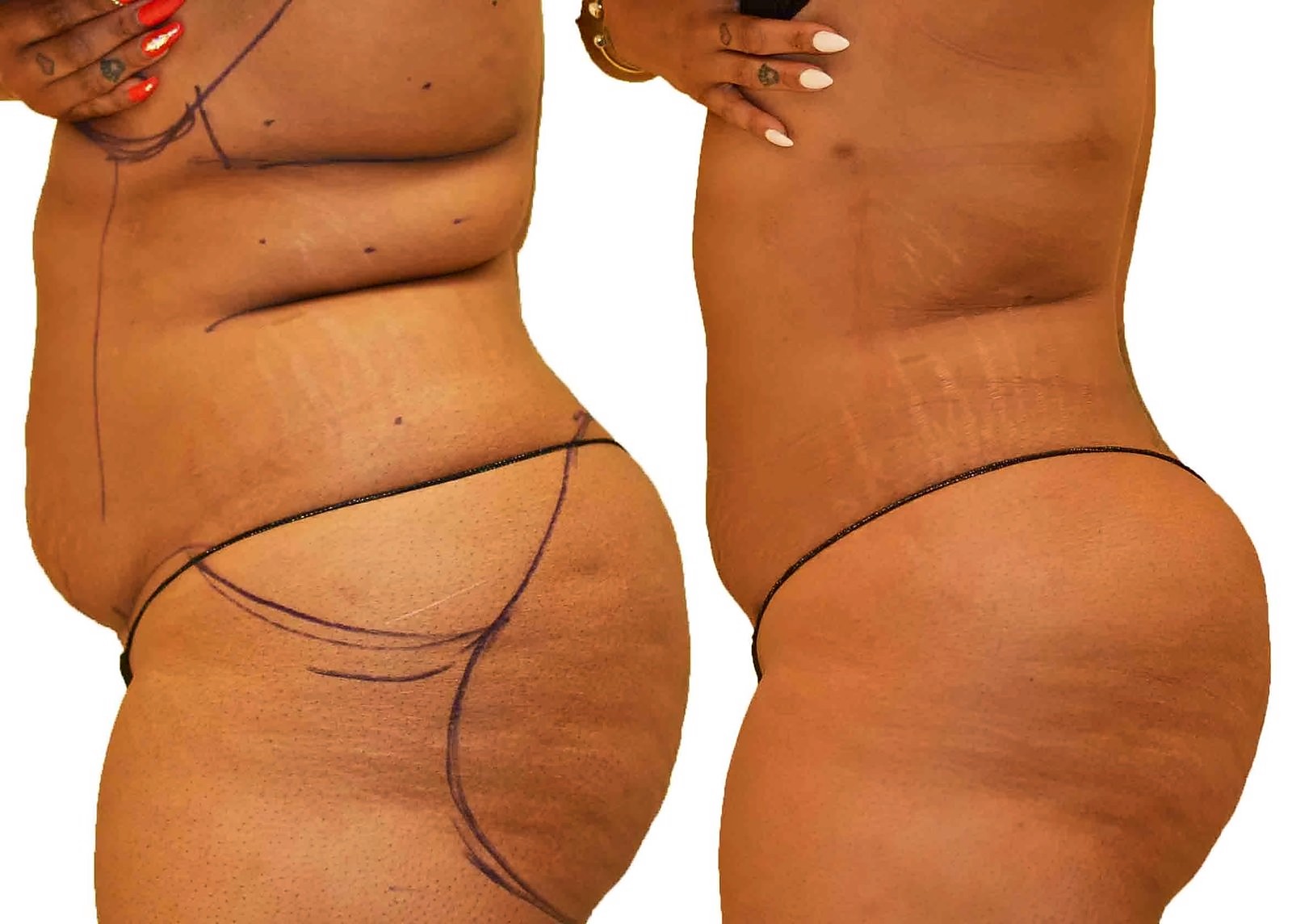Before/After Lipo 360 before and after, actual patient of Dr. Long